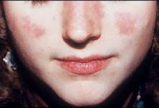 allergia